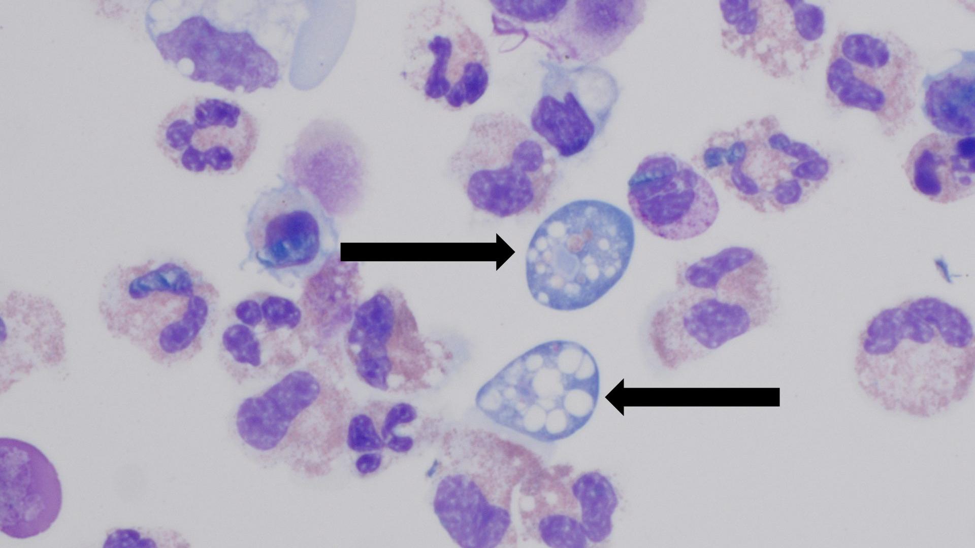North Carolina teen 'critically ill' after contracting same brain-eating amoeba that killed 8-year-old Louisiana girl