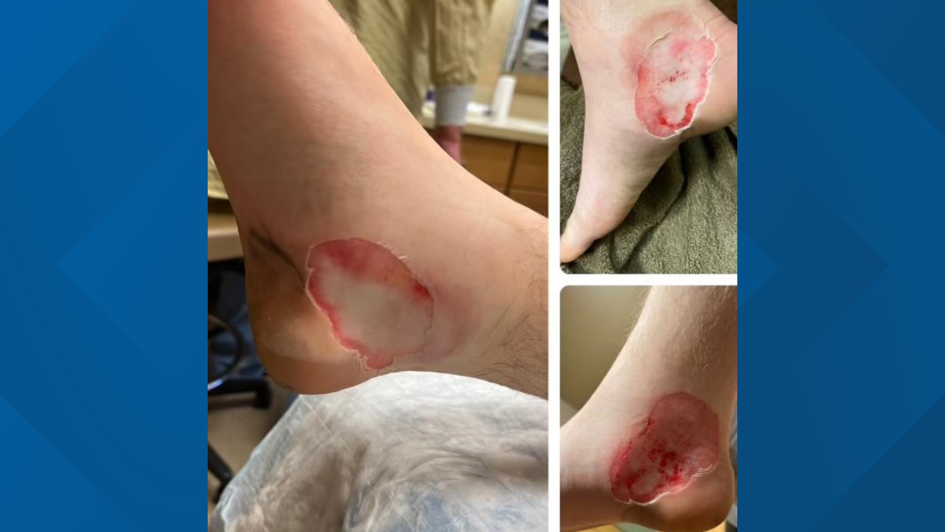 A Minnesota fisherman has a warning after the heated insoles he was wearing exploded and seriously burned his skin.