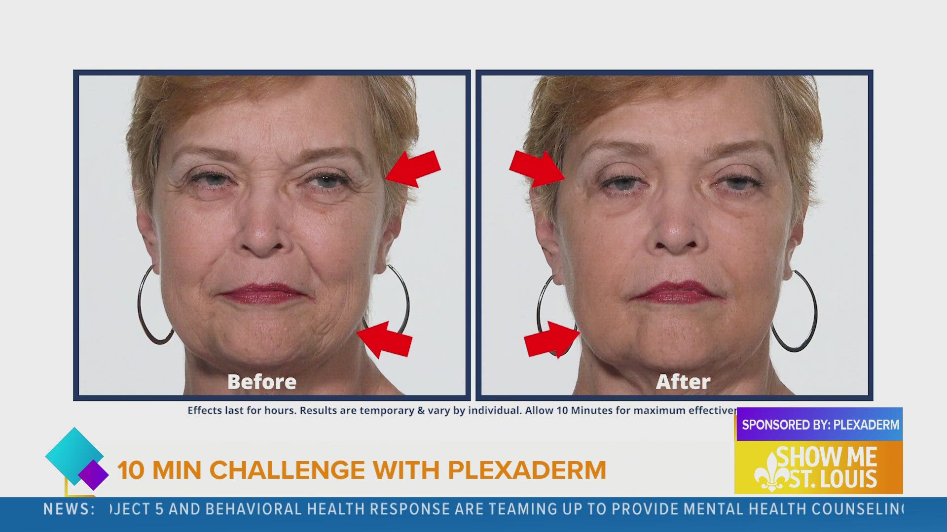 The time to try Plexaderm is now!