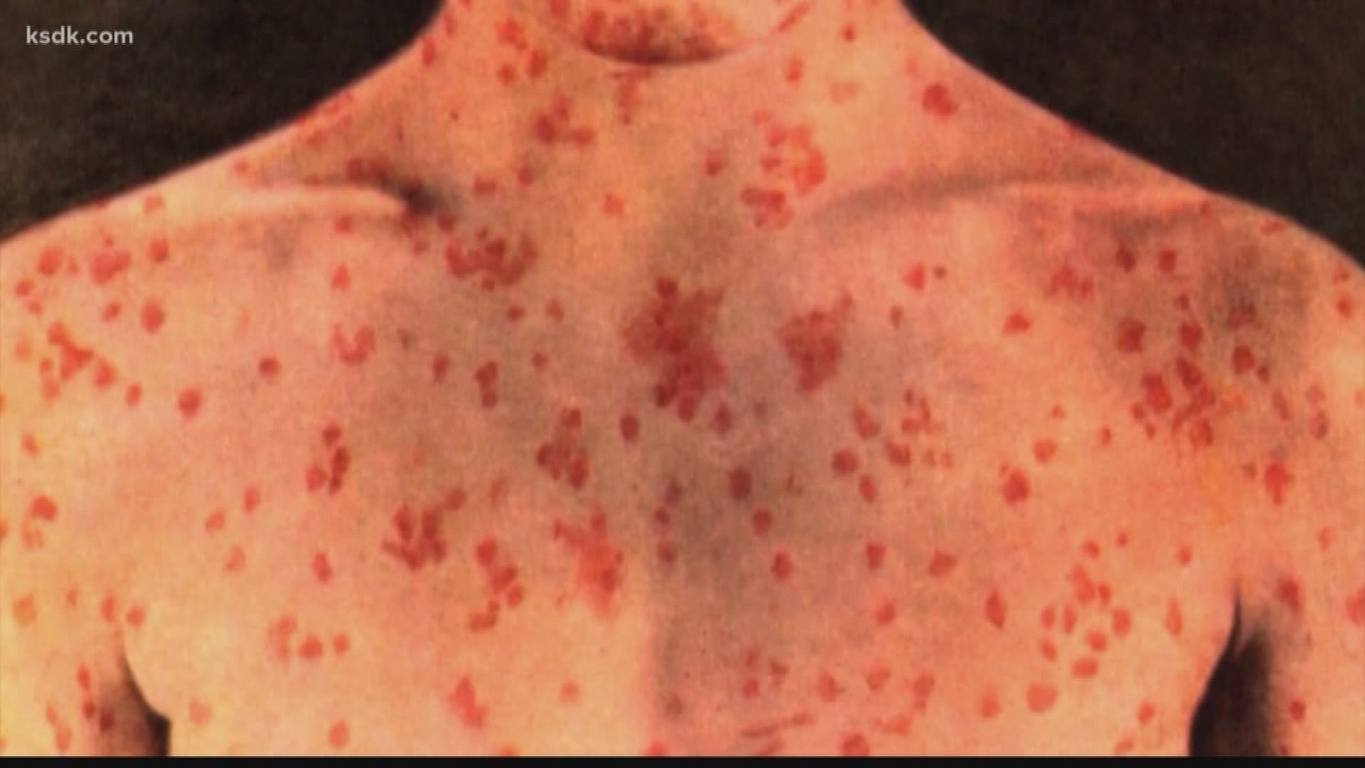 Measles can make you very uncomfortable, seriously ill and it is extremely contagious.
