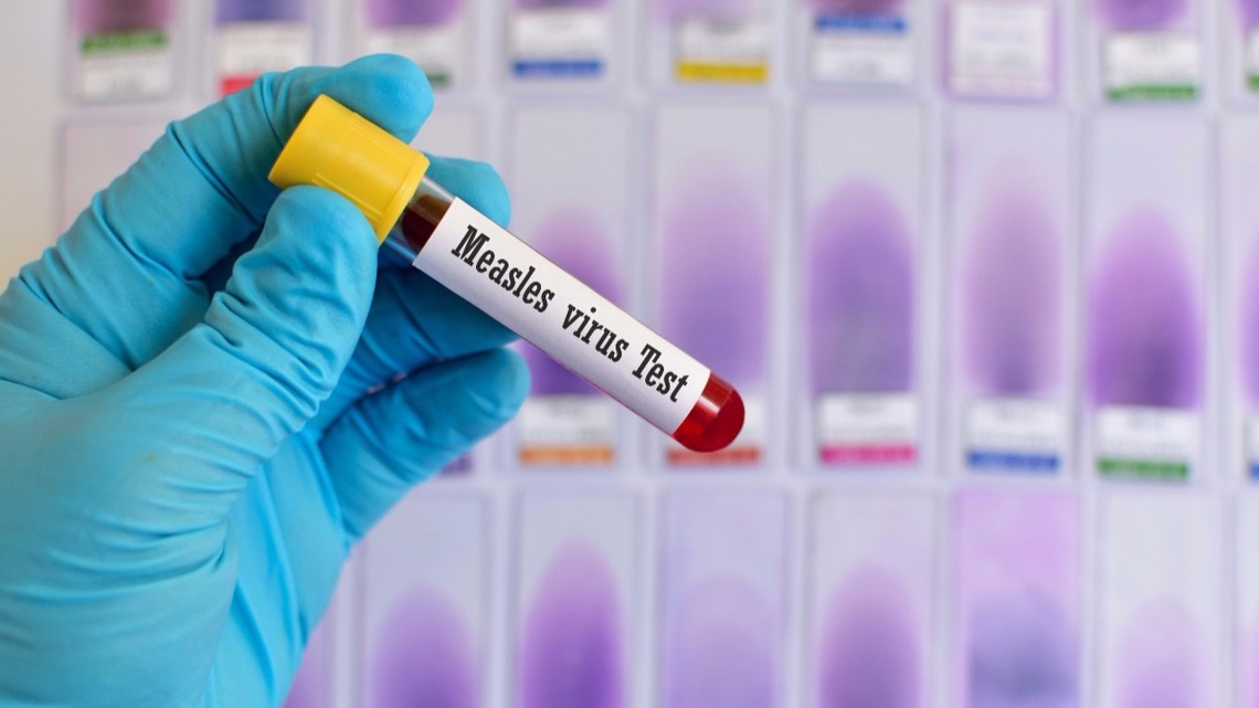 2nd measles case confirmed in Metro East area by Illinois health officials