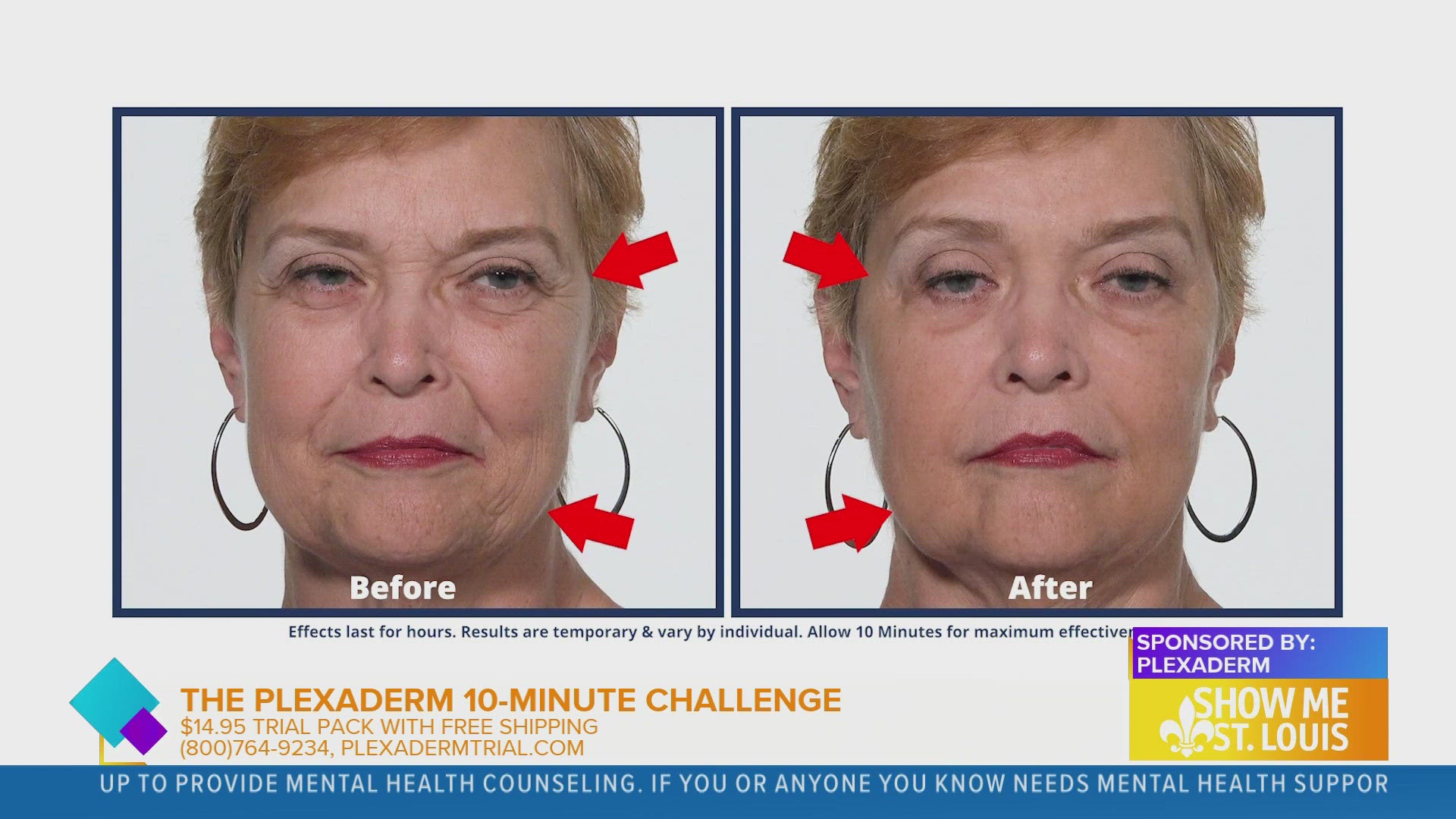 Plexaderm is a needle free way to shrink your under-eye wrinkles.