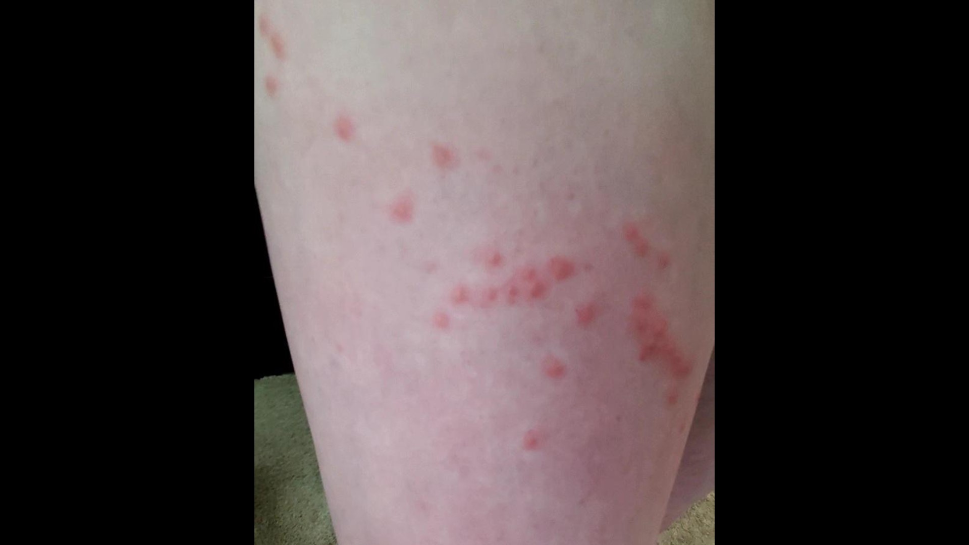 How to avoid getting bit by chiggers