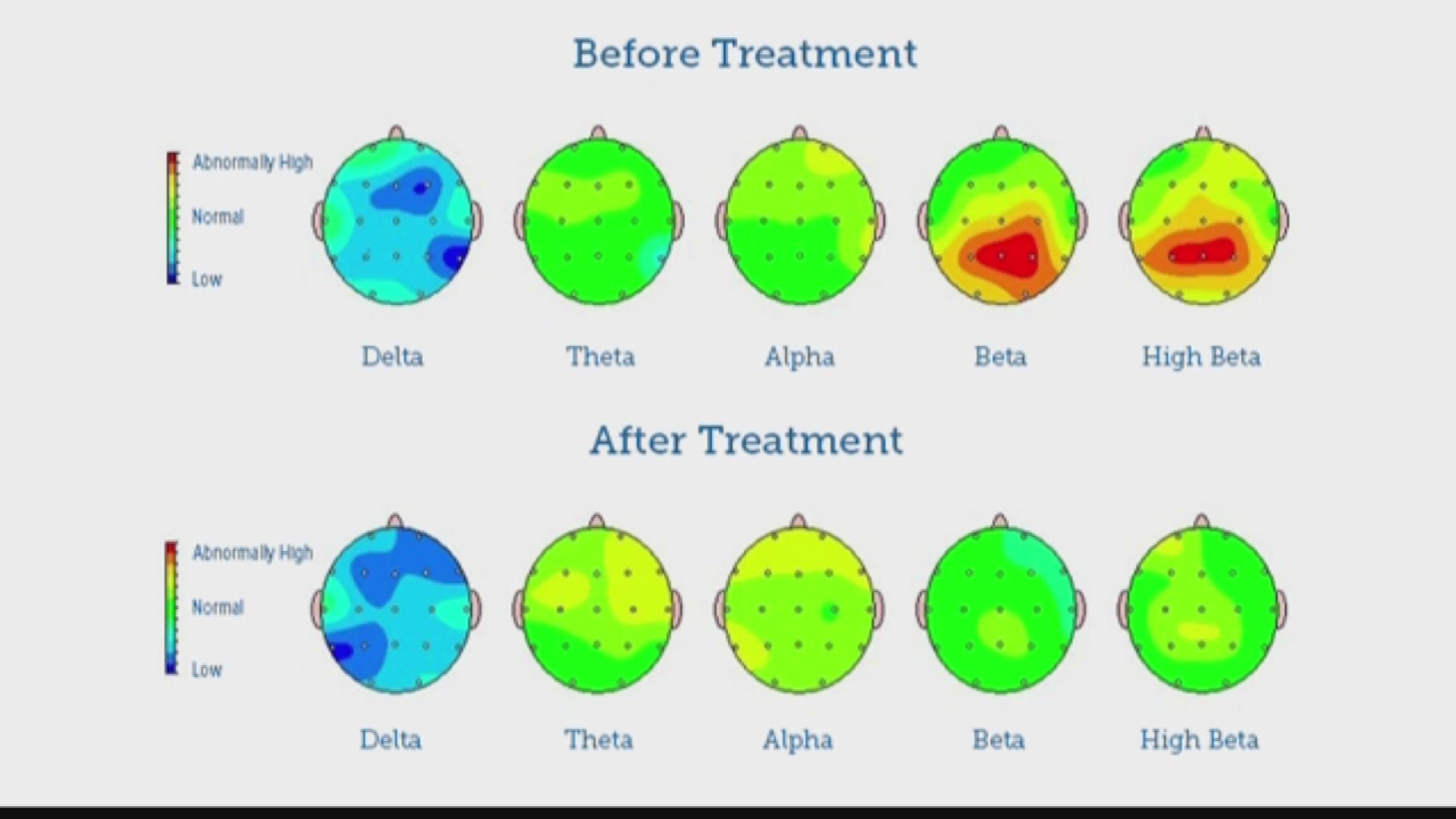 St. Louis Neurotherapy Institute uses Neurofeedback to find solutions.