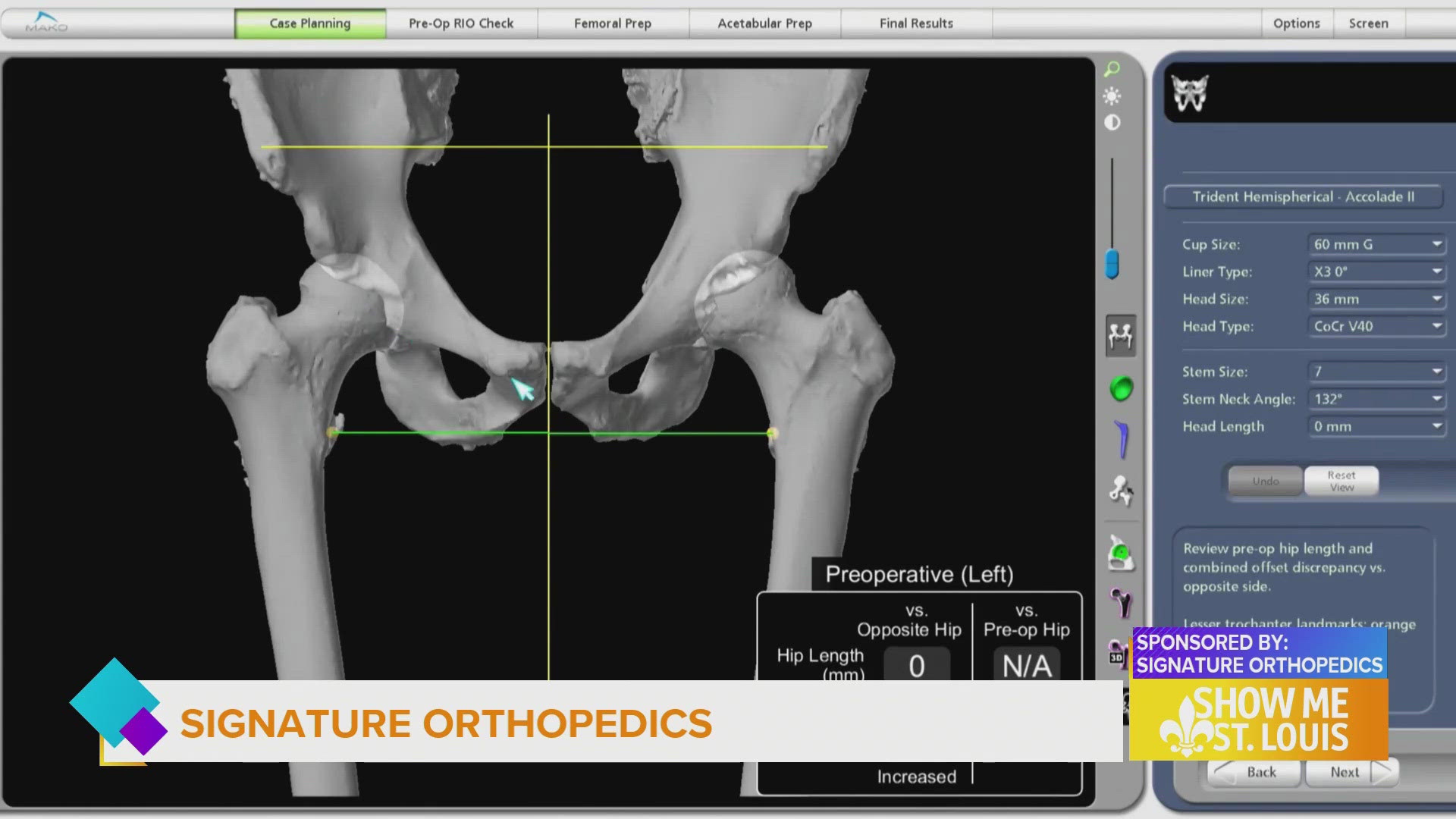 Dr. Christopher Palmer shares all about robotic joint replacement surgery and how it helped patients.