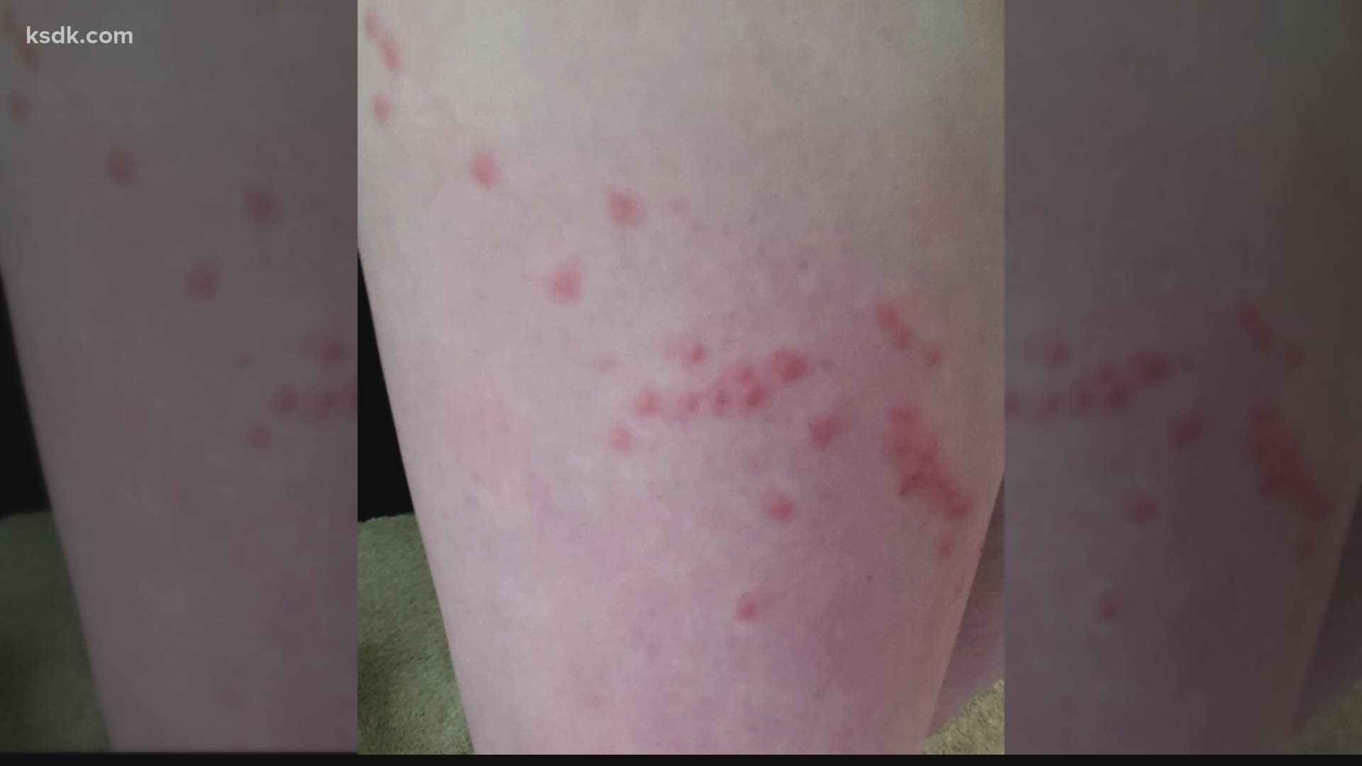 "It's like an overload of mosquitoe bites. It's like mosquito bites on steroids