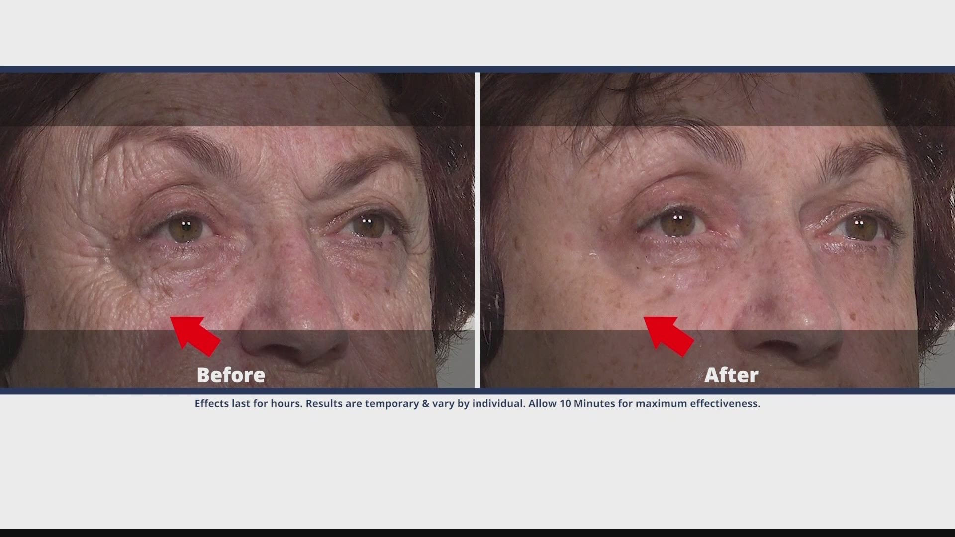 Plexaderm is a serum that can shrink your undereye bags and wrinkles!