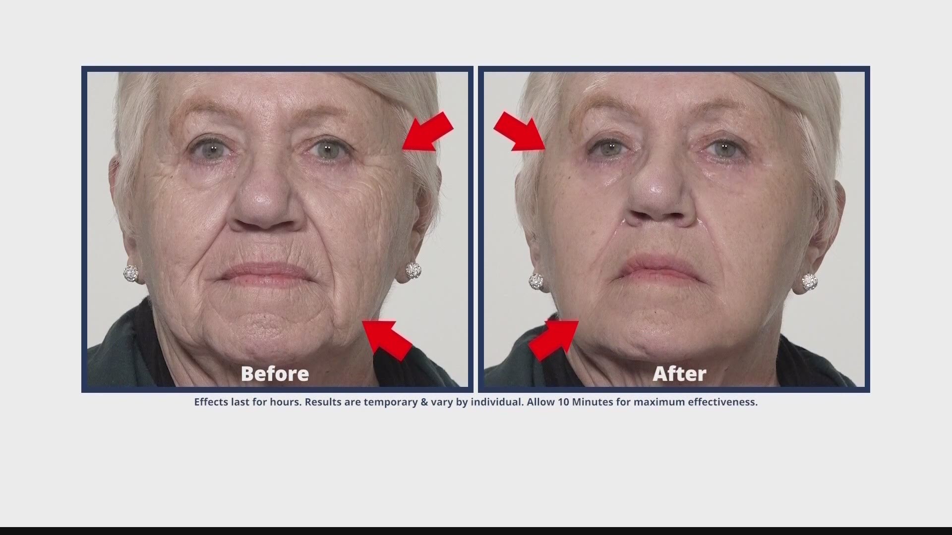 Plexaderm is a serum that can shrink your undereye bags and wrinkles!