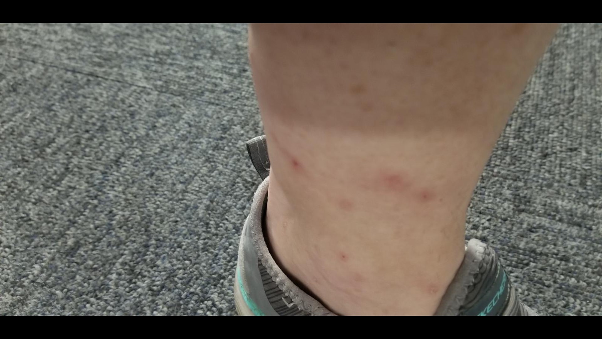 how-to-avoid-getting-bit-by-chiggers-ksdk