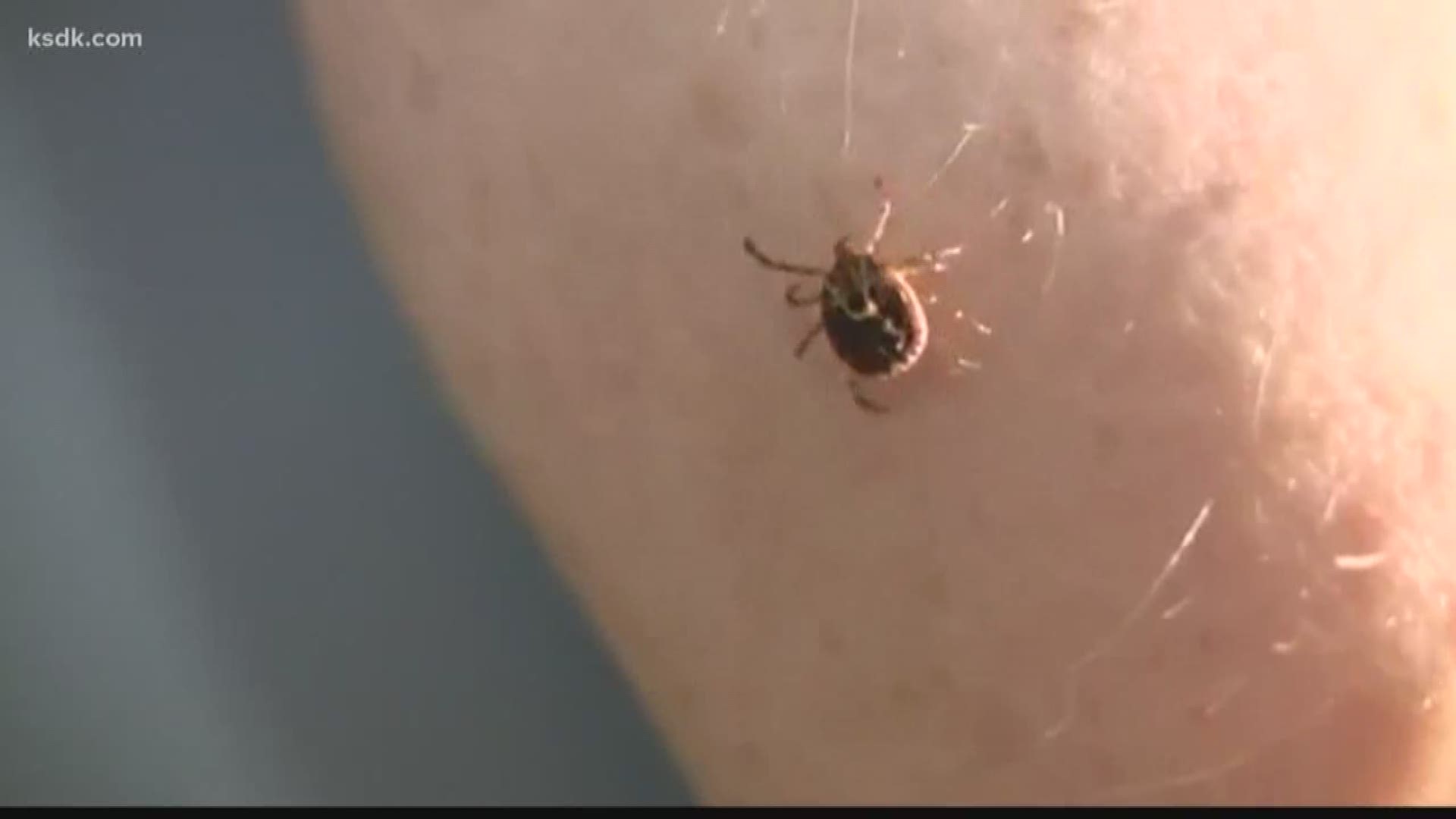 Ladue teen hospitalized after tick bite