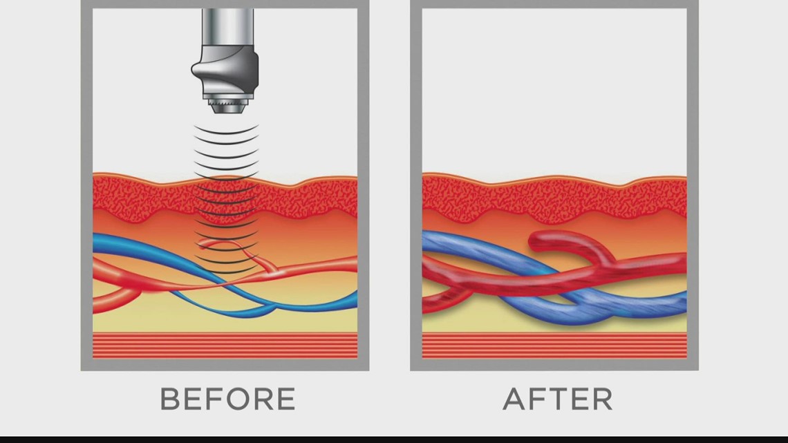 A revolutionary approach to treating ED | ksdk.com