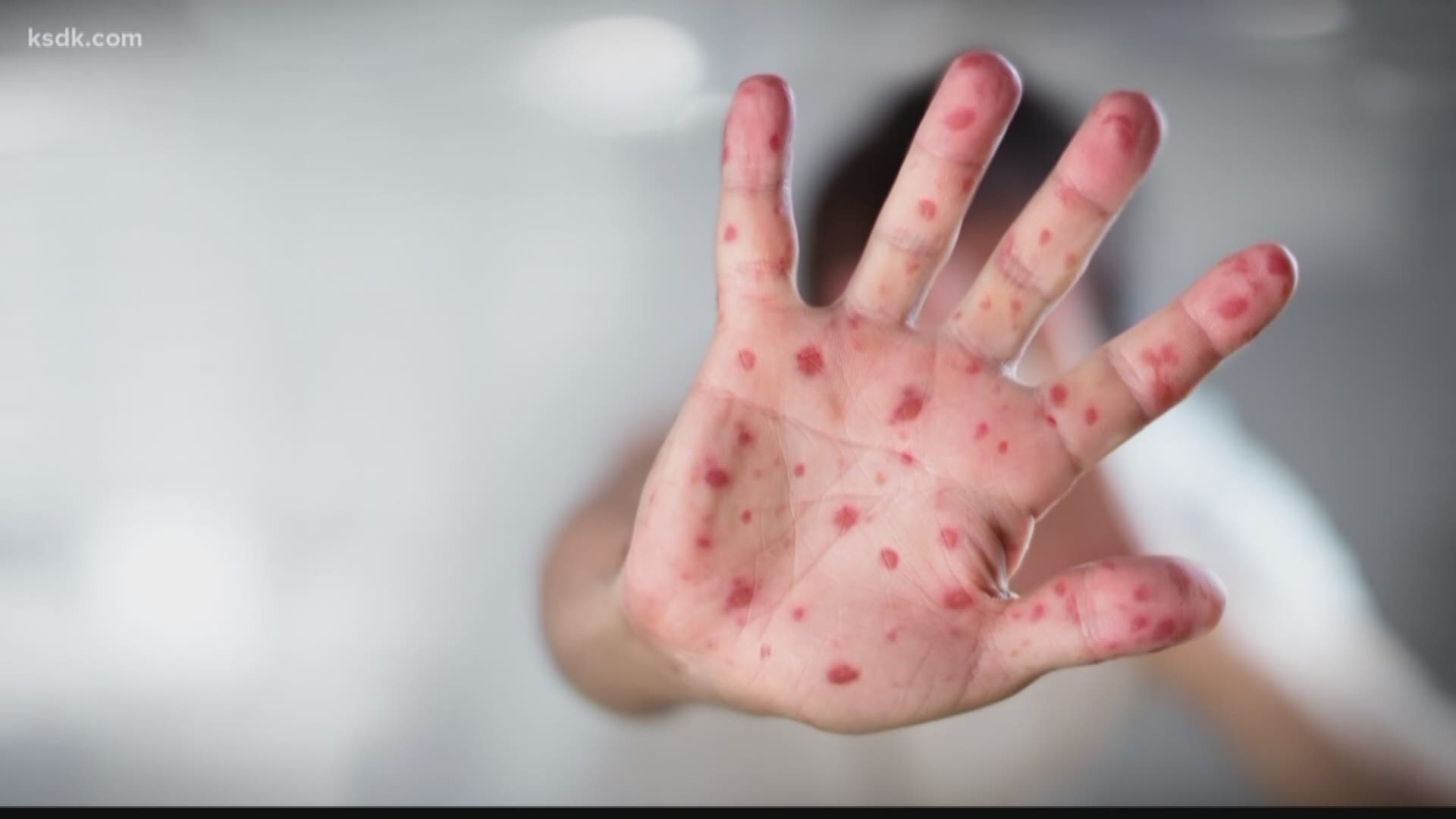 The health department is working to identify and contact anyone who may have been exposed to this case of measles.