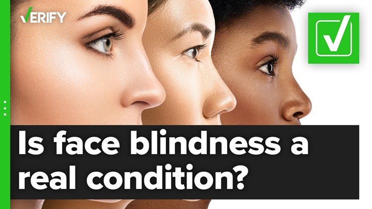 Face blindness is a real condition