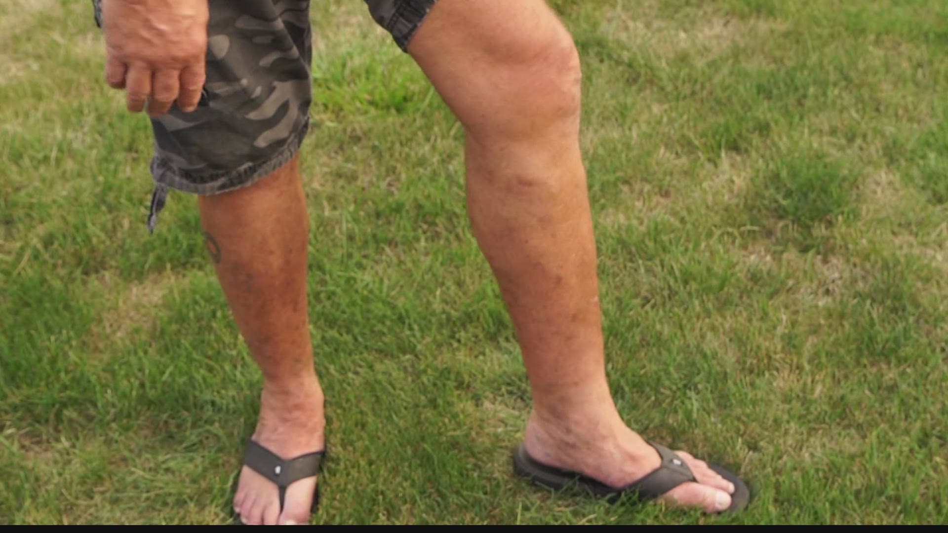 An Alexandria mechanic sought treatment because his legs gave him so much pain. Now, he's able to work and walk with no issues.